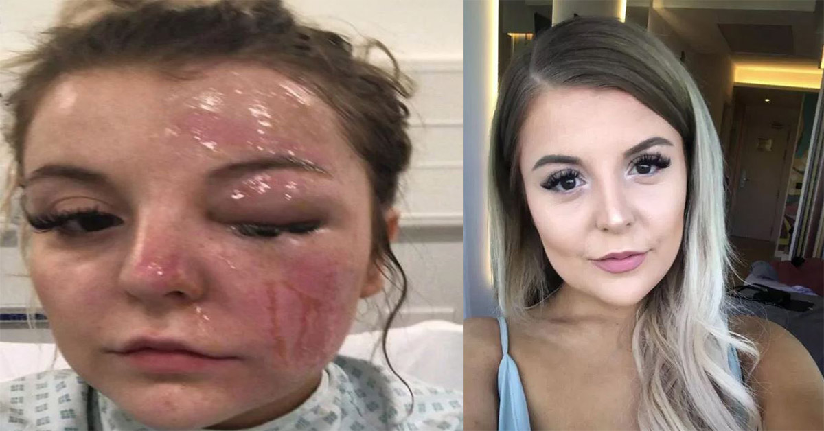 22-vjeçarja mbetet e verbër në njërin sy, i shpërthyen vezët në mikrovalë