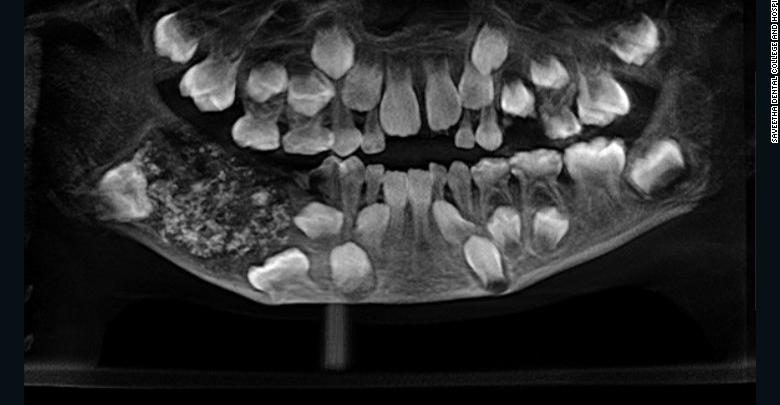Dentistët i gjejnë 7-vjeçarit 526 dhëmbë në gojë! (VIDEO)