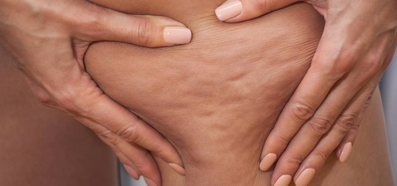 Ja pse të gjitha gratë kanë celulit