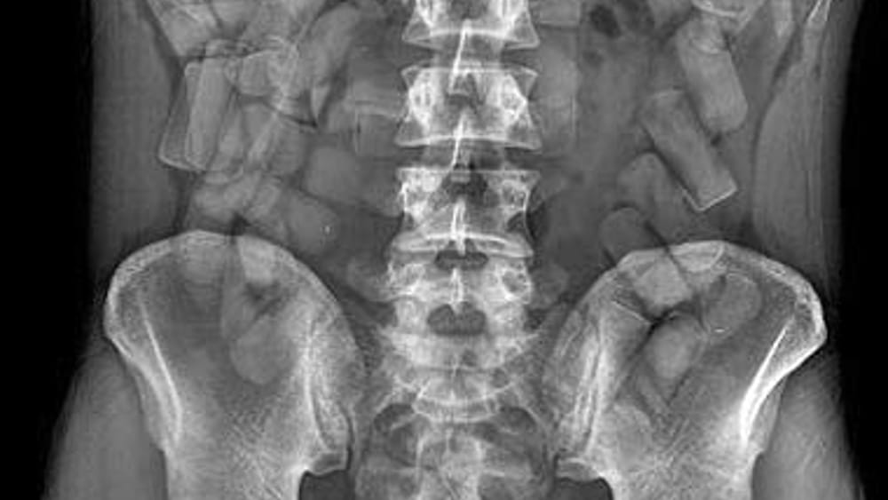 Mbi gjysmë kg heroinë e kokainë në stomak, 27-vjeçari përfundon në pranga dhe më pas në spital