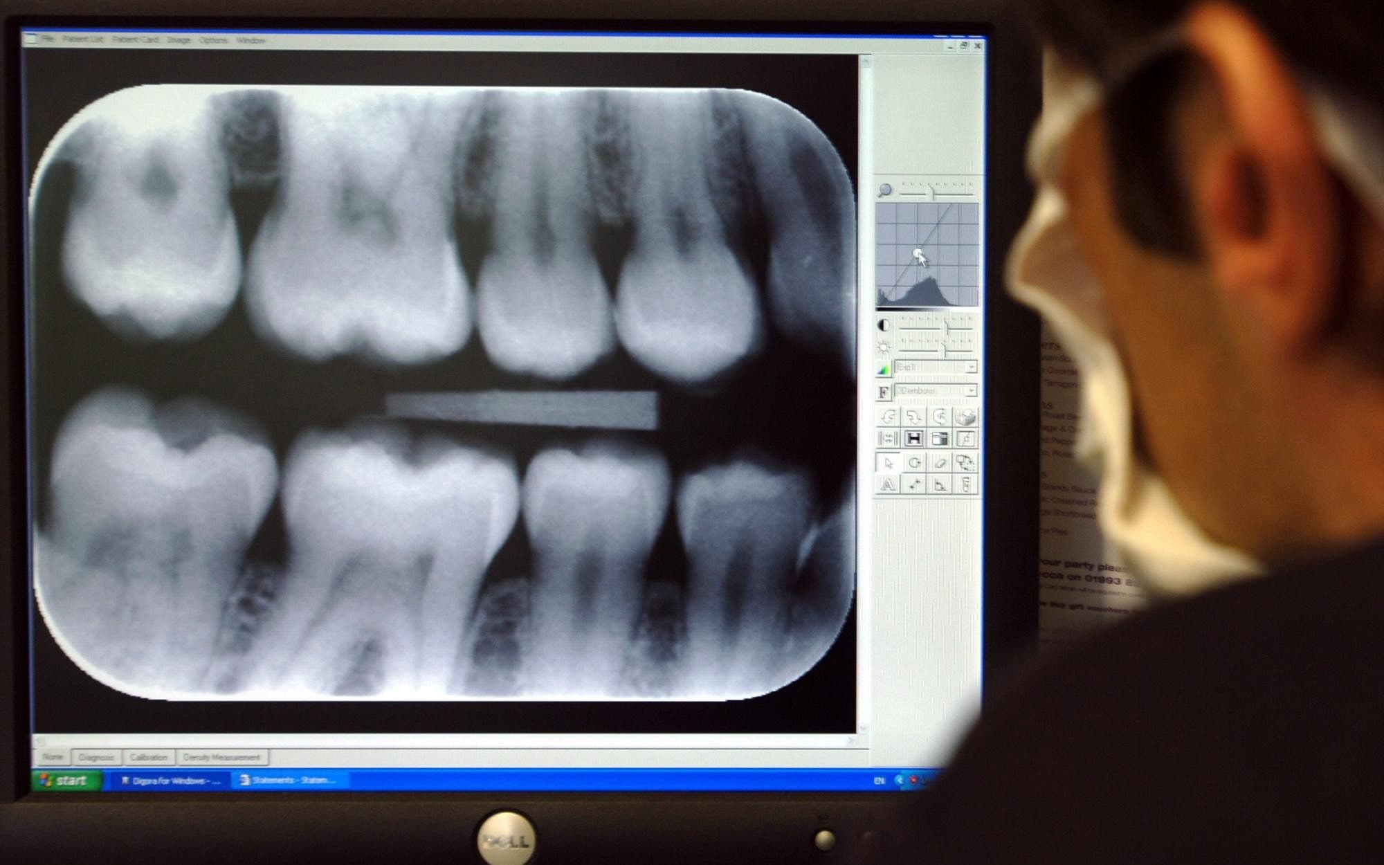 Dentisti i hoqi 10 dhëmbë, pacientja ndërron jetë