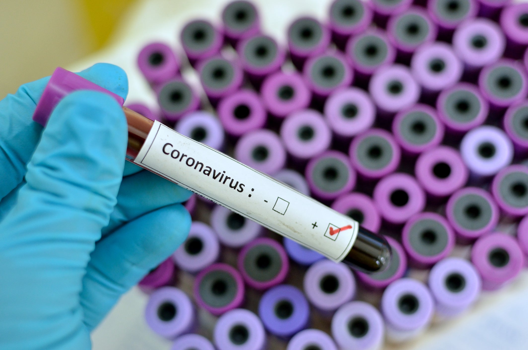 Pesë këshilla të rëndësishme për të ulur rrezikun e prekjes nga koronavirusi