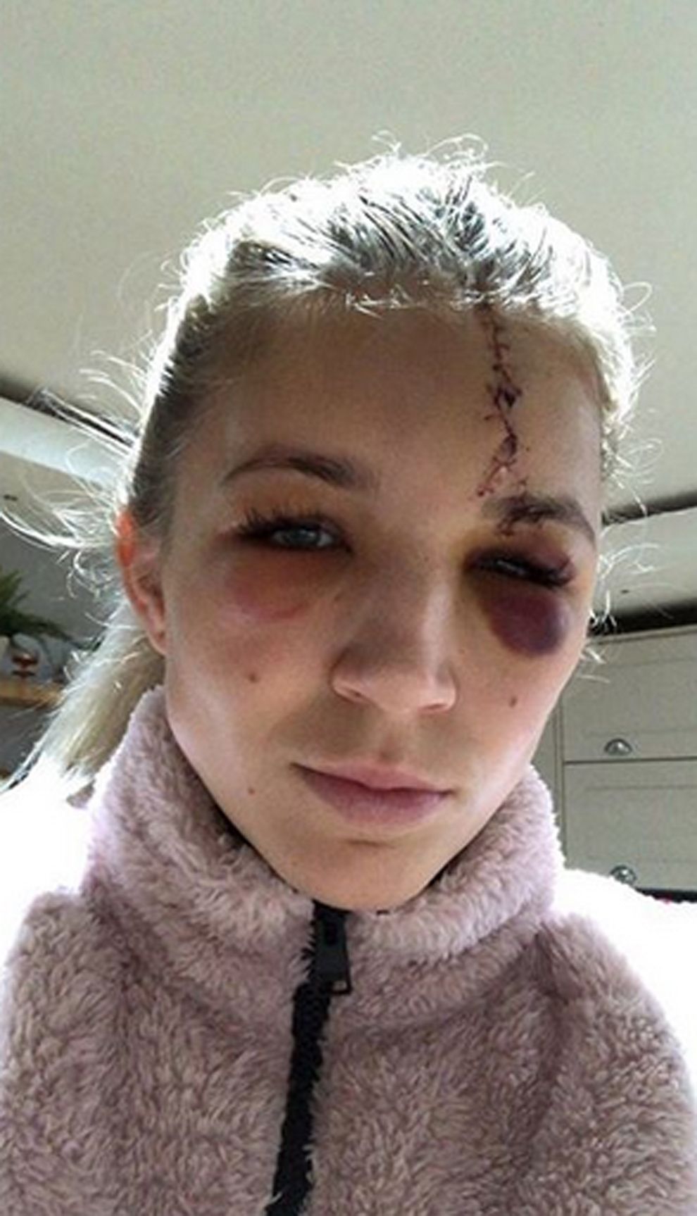 Dëmtimi horror i portieres së Liverpool