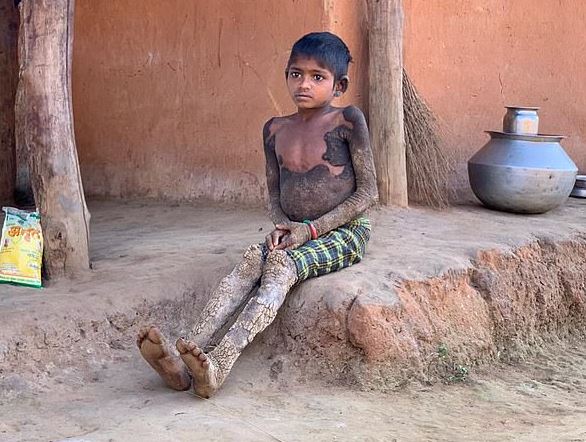 Vogëlushja 7-vjeçare që po “shndërrohet” në gur! (FOTO)