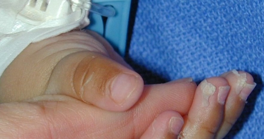 Një sëmundje e rrallë prek disa fëmijë me COVID-19