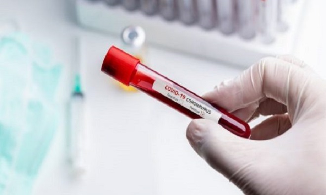 Sa vdekjeprurës është Covid-19?