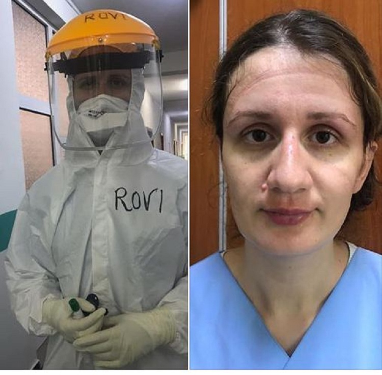 Si janë bërë fytyrat e mjekëve shqiptarë nga maskat (FOTO)