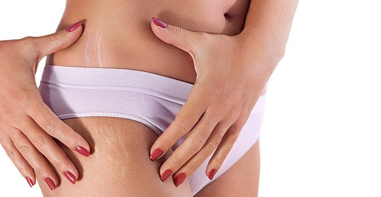 Trajtimi natyral për largimin e shenjave të shkaktuara nga luhatjet e peshës