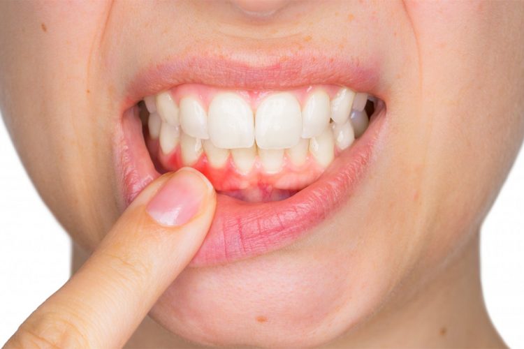 Kjo është sëmundja që shkakton rënien e dhëmbëve, ja si mund ta parandaloni