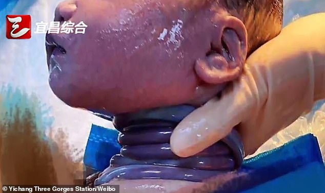 6 herë kordonin të mbledhur rreth qafës, foshnja habit mjekët (VIDEO)