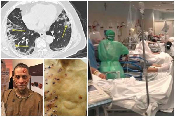 Brataj publikon fotot rrëqethëse: Koronavirusi nuk shfaqet me shenja që vihen re, dëmtimet nuk ia shohim