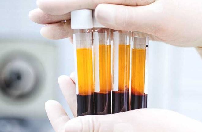 Shërim me plazmën e të infektuarve, Maqedonia e Veriut kërkon dhurues gjaku