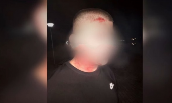 Shkeli orën policore, rrihet keq nga policia një 19-vjeçar në Mitrovicë