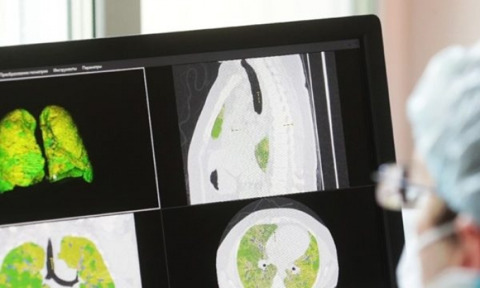 Gruaja vdes pas transplantit të mushkërive, ishin të infektuara me Covid-19