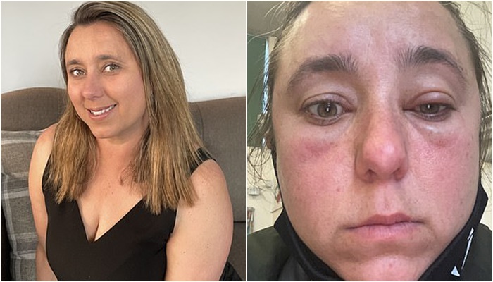 Merr dozën e parë të vaksinës AstraZeneca, transformohet në fytyrë