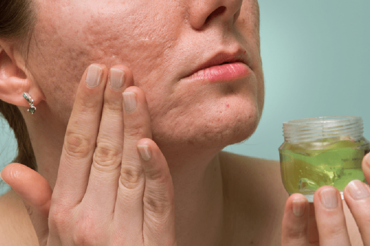 Tre trajtime të shpejta për të larguar shenjat e akneve