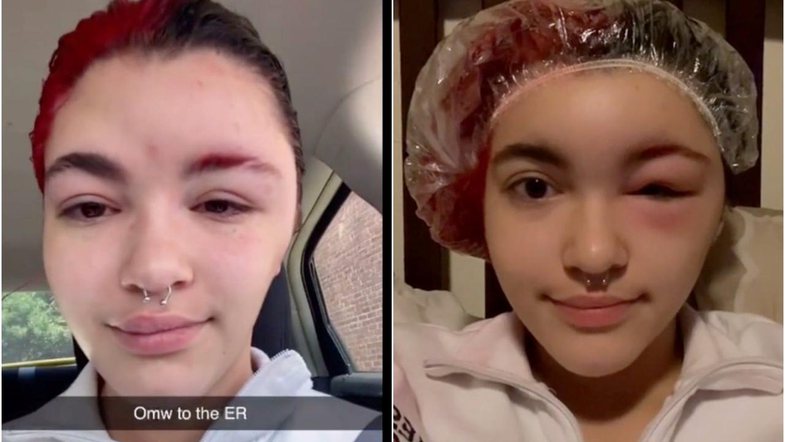 Përfundoi në spital, pasi lyerja e flokëve “përfundoi” keq