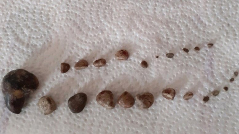 Pacientit në Kosovë i hiqen mbi 20 gurë nga veshkat