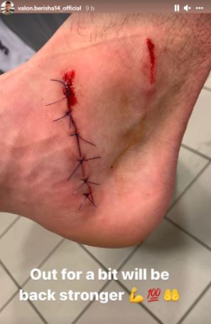 Dëmtim “horror”, mesfushori shqiptar publikon pamjet e këmbës së tij