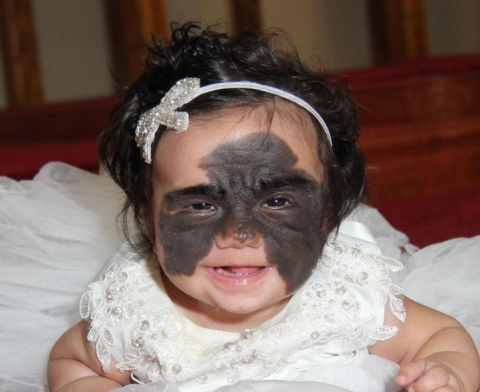 Njerëzit e quanin “monstër”, 2-vjeçarja ndryshon pamjen pas operacioneve: “Tani jam princeshë”(FOTO)