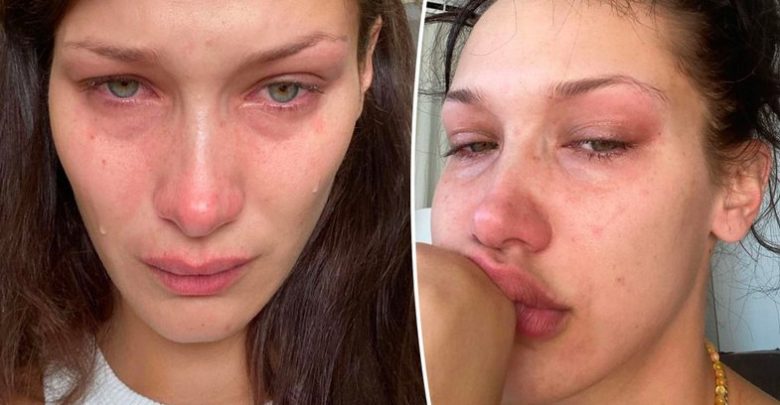 Bella Hadid rrëfen “betejën” torturuese me problemet e shëndetit mendor