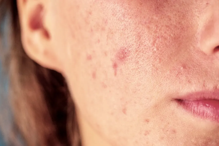 A i përkeqëson stresi problemet me lëkurën? – Çfarë duhet të bëni