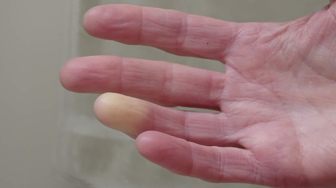 Nëse duart dhe këmbët ju mpihen e ndryshojnë ngjyrë kur është ftohtë, vuani nga kjo sëmundje