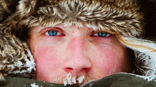 I ftohti mund të “shkatërrojë” fytyrën tuaj,  si ta shmangni këtë