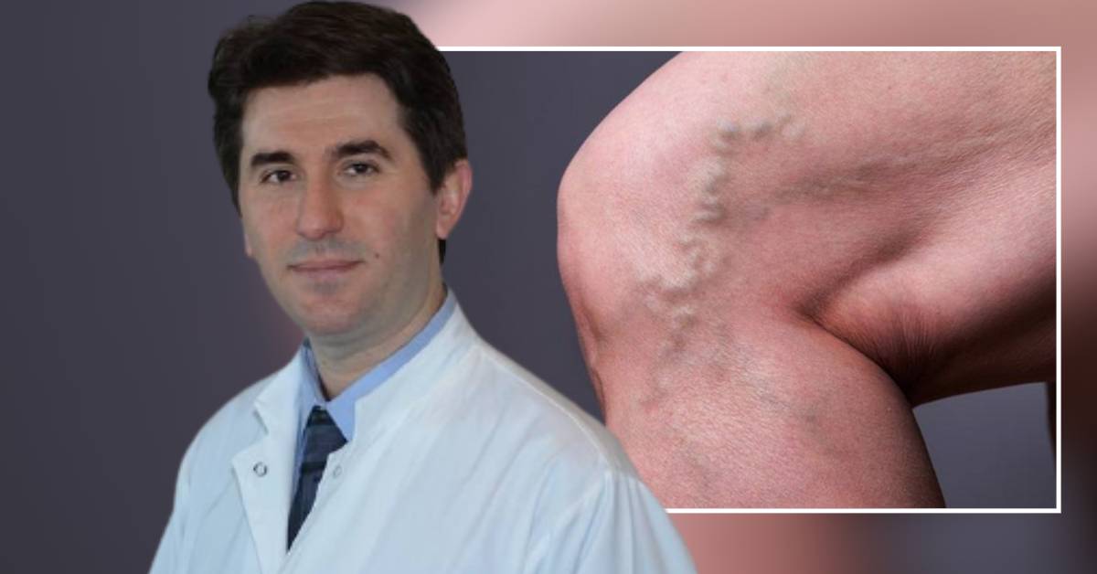 Gjenetike apo mënyra e jetesës? Mjeku tregon si shfaqen variçet në trupin e njeriut dhe si trajtohen