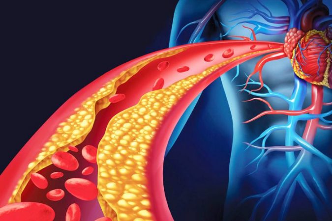 Dëmet që i shkakton kolesteroli i lartë zemrës dhe trurit, kujdesi që ju duhet
