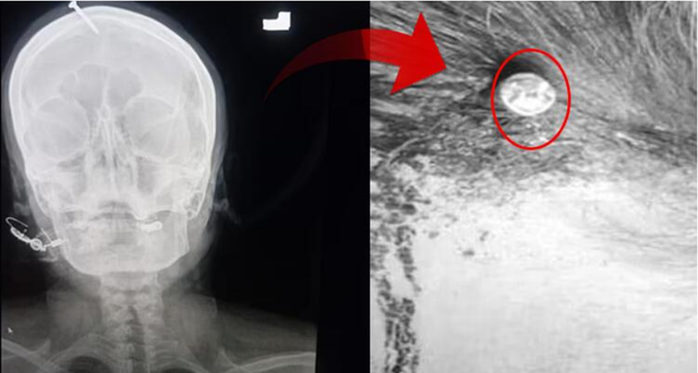 Lindi tre vajza, gruas i ngulin gozhdë në kokë për të patur një djalë