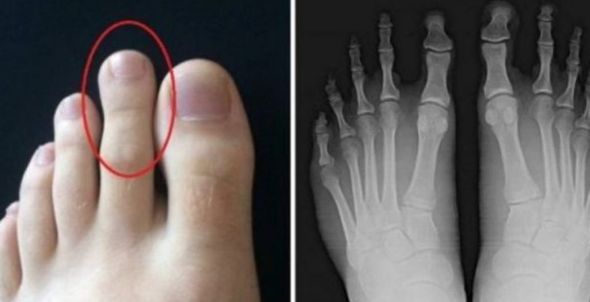Nëse e keni gishtin e dytë më të gjatë se të madhin jeni në rrezik, kjo është arsyeja