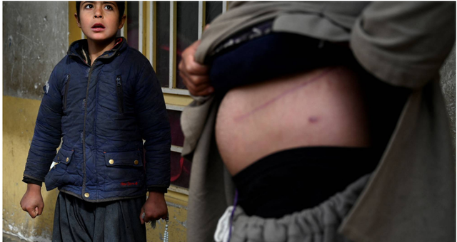 Tmerr në Afganistan/ Prindërit në varfëri ekstreme shesin veshkat e fëmijëve për të fituar para