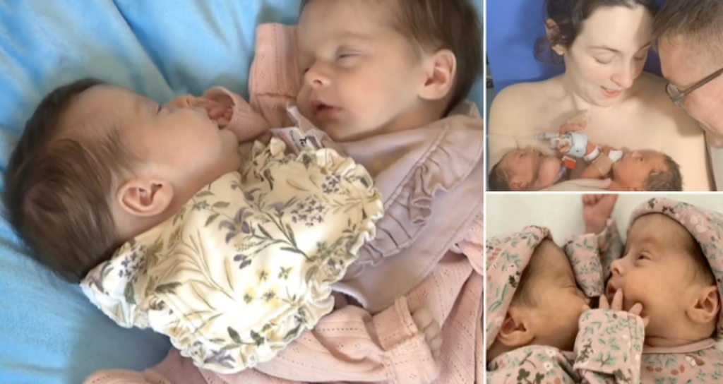 Çifti sjell në jetë binjakët e bashkuar, ndodh 1 herë në 2 milion