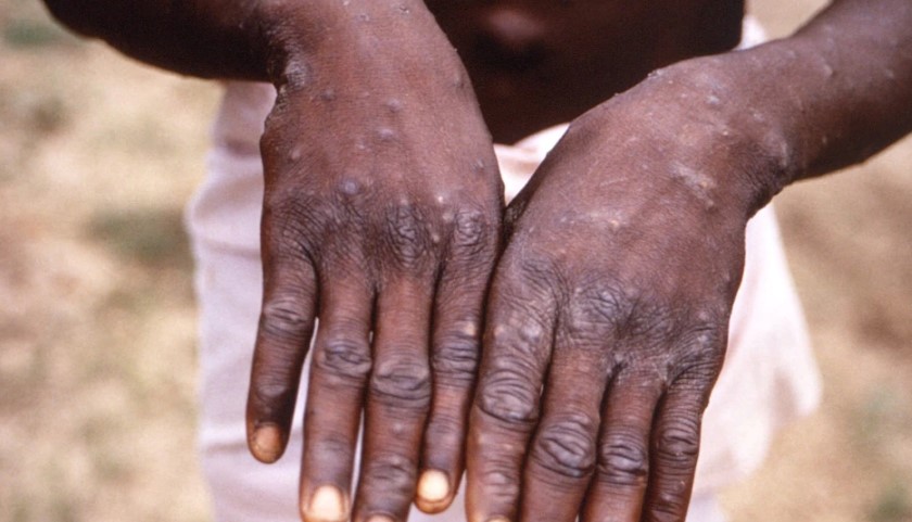 Sa të shqetësuar duhet të jemi nga lija e majmunëve? Ekspertët ngrenë alarmin: Infeksioni mund të rritet pasi…