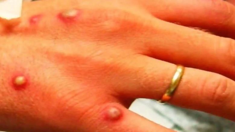 Lija e majmunëve po përhapet, OBSH: Bota po përballet me sfida “të frikshme”