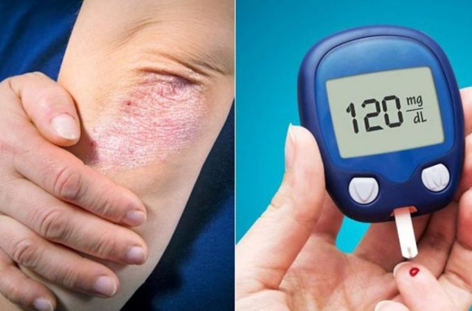 Si ndryshojnë simptomat e diabetit te gratë dhe burrat, çfarë duhet të dini