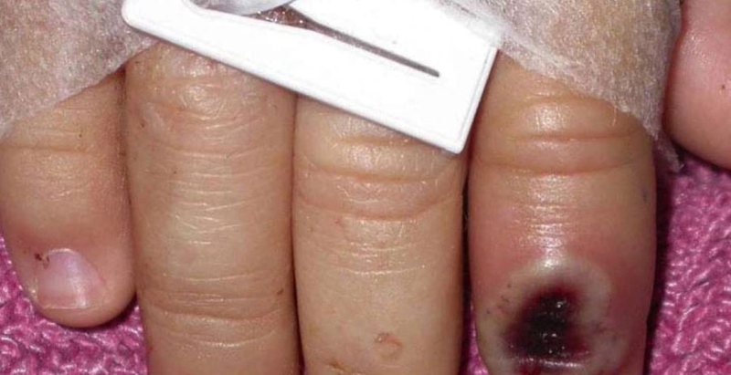 Lija e majmunëve shumë pranë Shqipërisë, regjistrohet rasti i parë në…