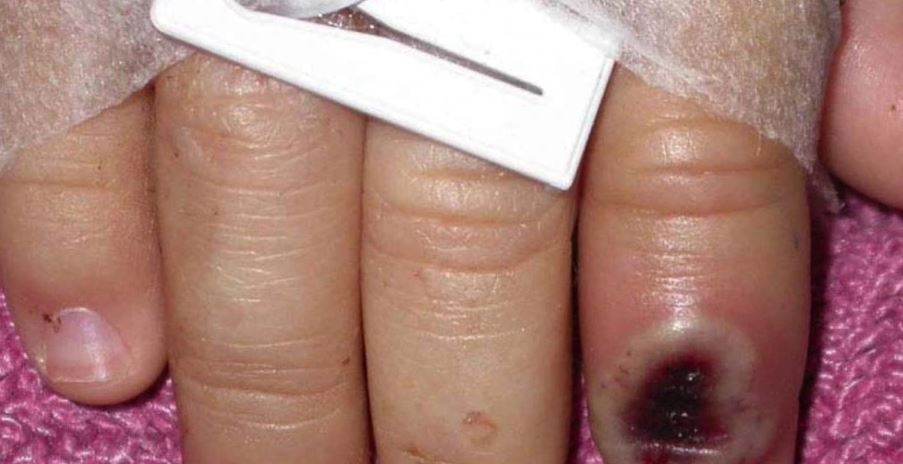 Lija e majmunëve i afrohet Shqipërisë, konfirmohet rasti i parë në…