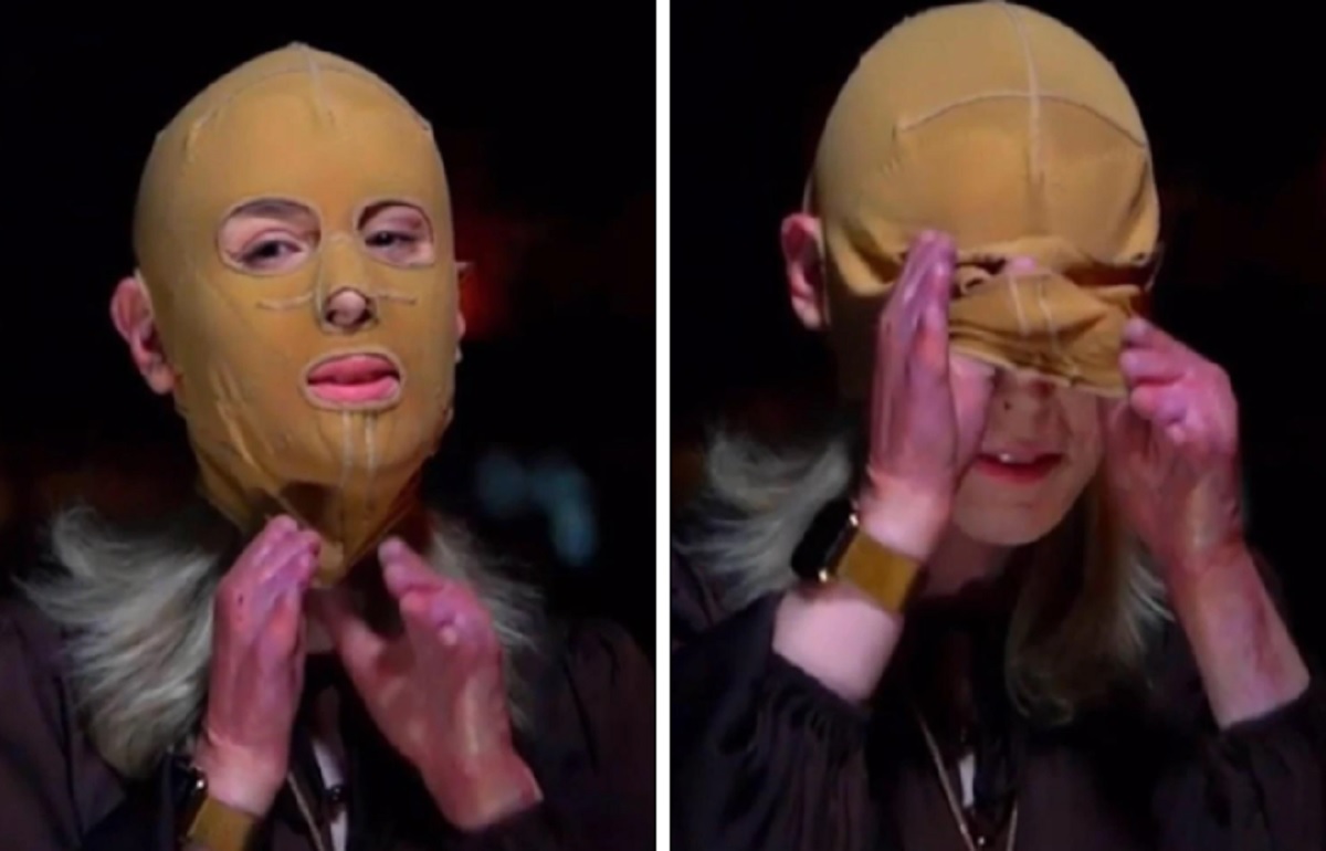 U dogj në 70% të trupit nga vullkani, e mbijetuara heq për herë të parë maskën në një intervistë(FOTO)