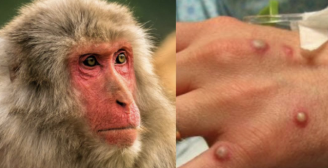 OBSH shpall linë e majmunëve emergjencë globale