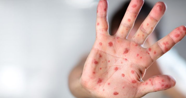 U infektua me linë e majmunëve, turisti italian ndërron jetë në Kubë