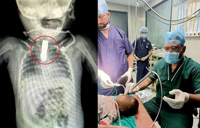 Fëmija 8 muajsh gëlltit prerësen e thonjve, mjekët mrekullisht ia heqin nga fyti me operacion (FOTO)