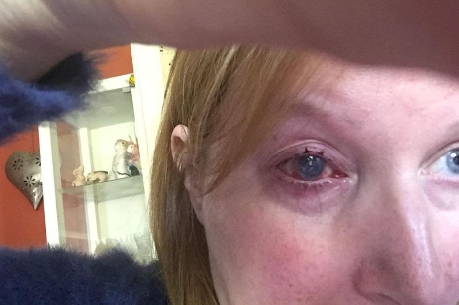 54-vjeçarja humb syrin nga një infektim bakterial në dush