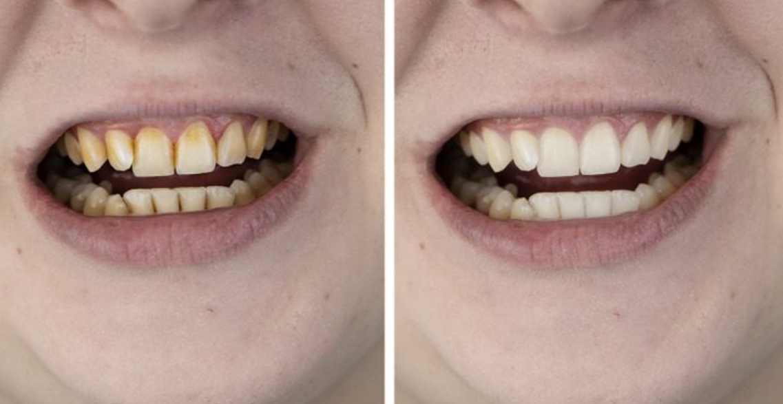 Pse nuk duhet t’i lani kurrë dhëmbët sapo zgjoheni në mëngjes