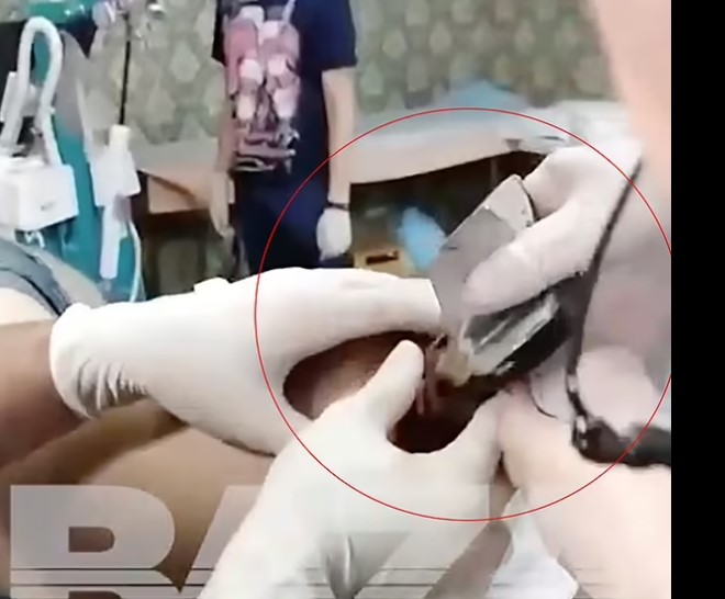 Pamje të rënda, mjekët i heqin nga shpina predhën e pashpërthyer ushtarit rus (VIDEO)