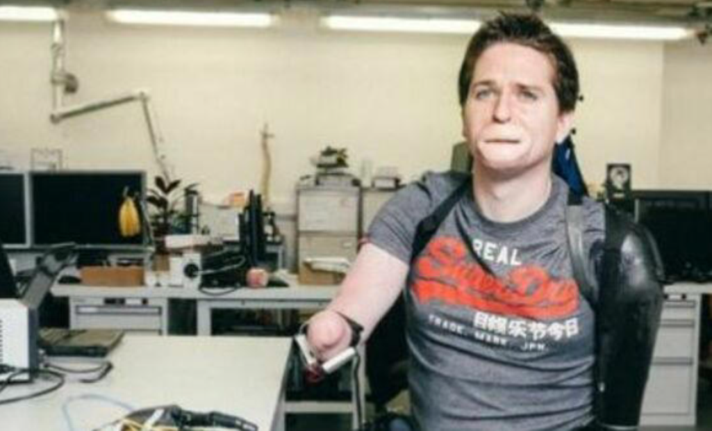 Mendoi se kishte grip, por 42-vjeçari ngeli pa gjymtyrë dhe me fytyrë të shpërfytyruar nga bakteri vrasës