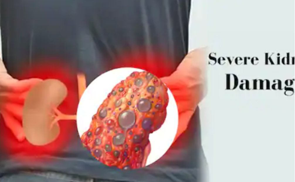 Infeksioni i rëndë i fshikëzës së tëmthit mund t’i dëmtojë plotësisht veshkat tuaja, simptomat