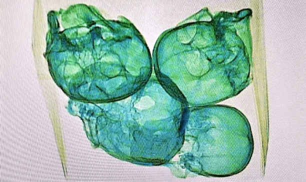 U dërguan me postë drejt SHBA-ve, kapen në aeroport katër kafka njerëzish