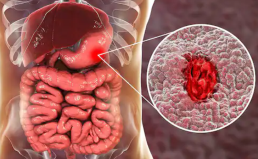 Ulçera gastrike: 7 simptoma të pazakonta së ulçerës peptike që duhet të dini